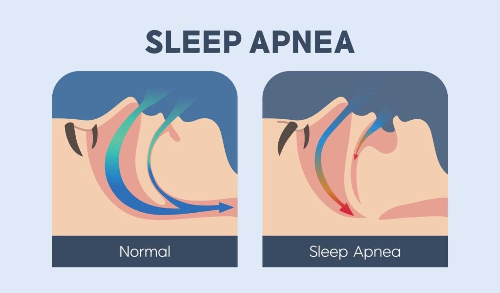 what is sleep apnea
